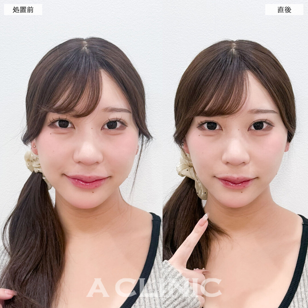 Aスレッドでフェイスラインを整えて自然に垢抜けました！こちら処置前と直後の症例です(20代女性)