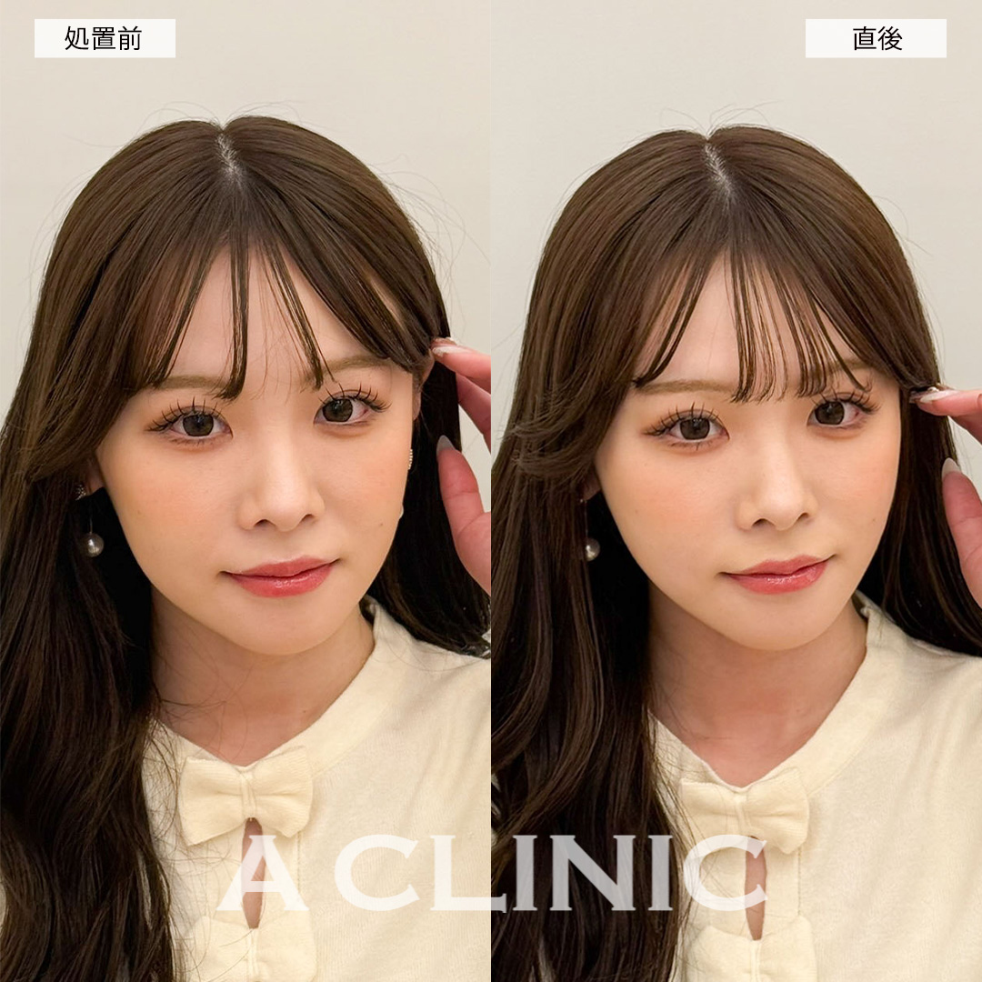 Aスレッドで左右差のない美しいファイスラインに！こちら処置前と直後の症例です(20代女性)