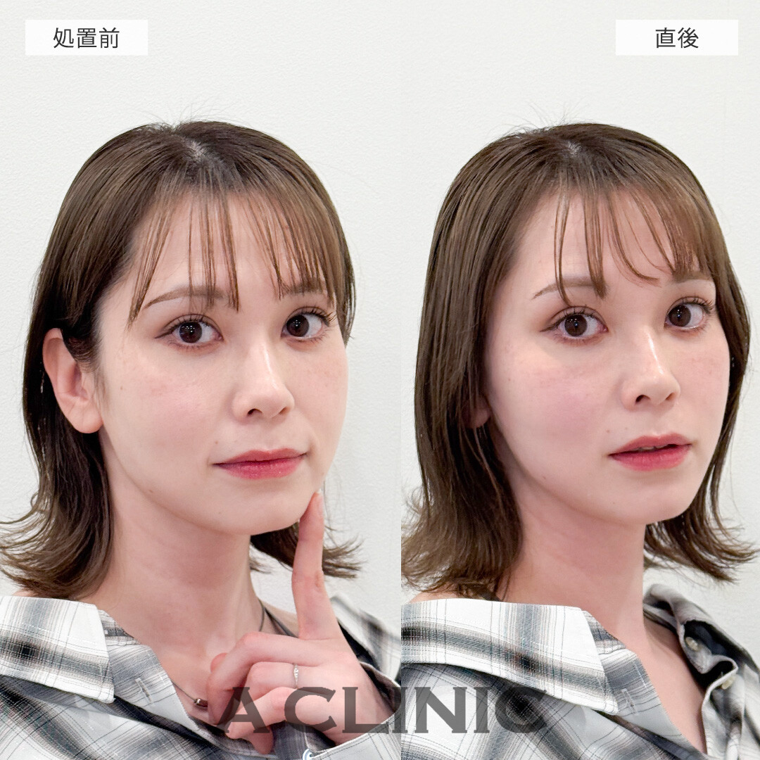 ダウンタイム最小限でたるみを解消してシュッとした輪郭に！Aスレッドの処置前と直後の症例です(30代女性)