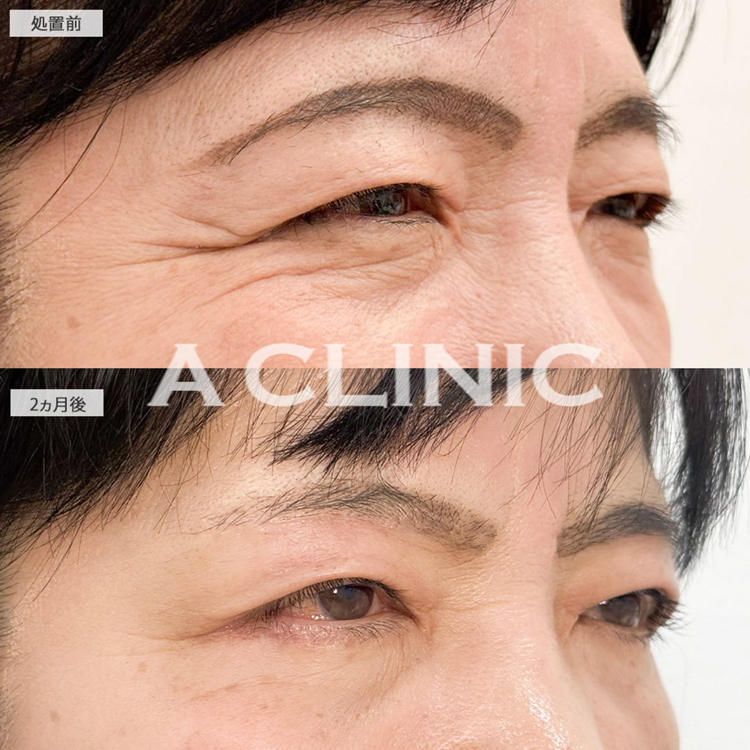 複合施術でお顔の印象が柔らかくなり自分に自信が持てるようになりました！処置前と2ヶ月後の症例です(60代女性)