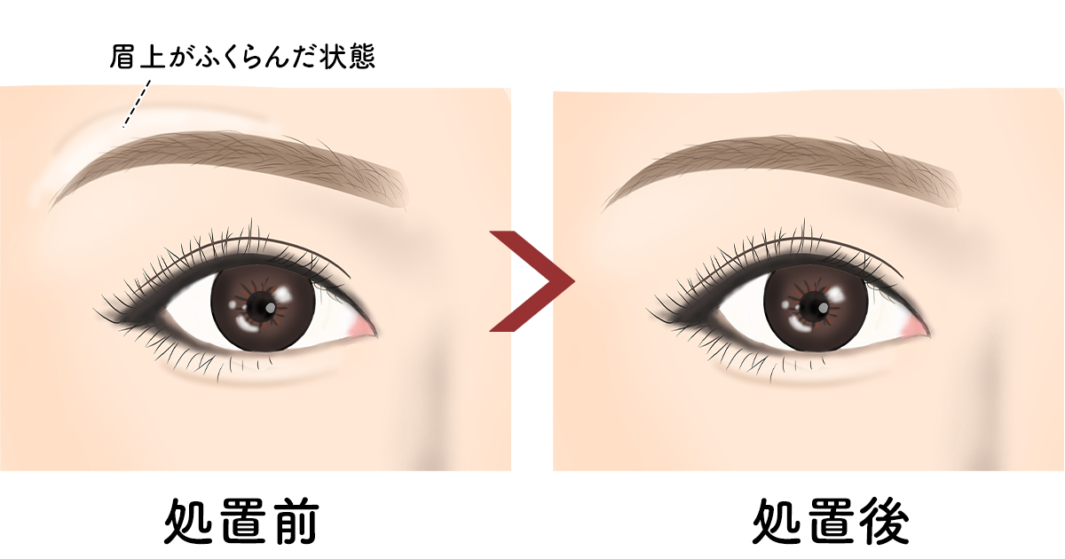 眉上のボトックス部位説明