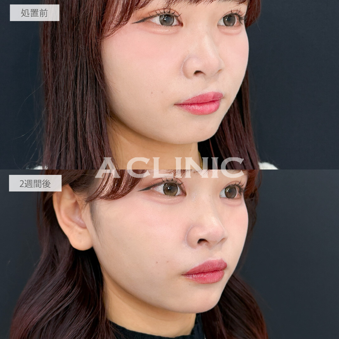 ヒアルロン酸カスタマイズメニューで部分ごとに悩みが解消できて自然なアップデートができました！処置前と2週間後の症例です(20代女性)
