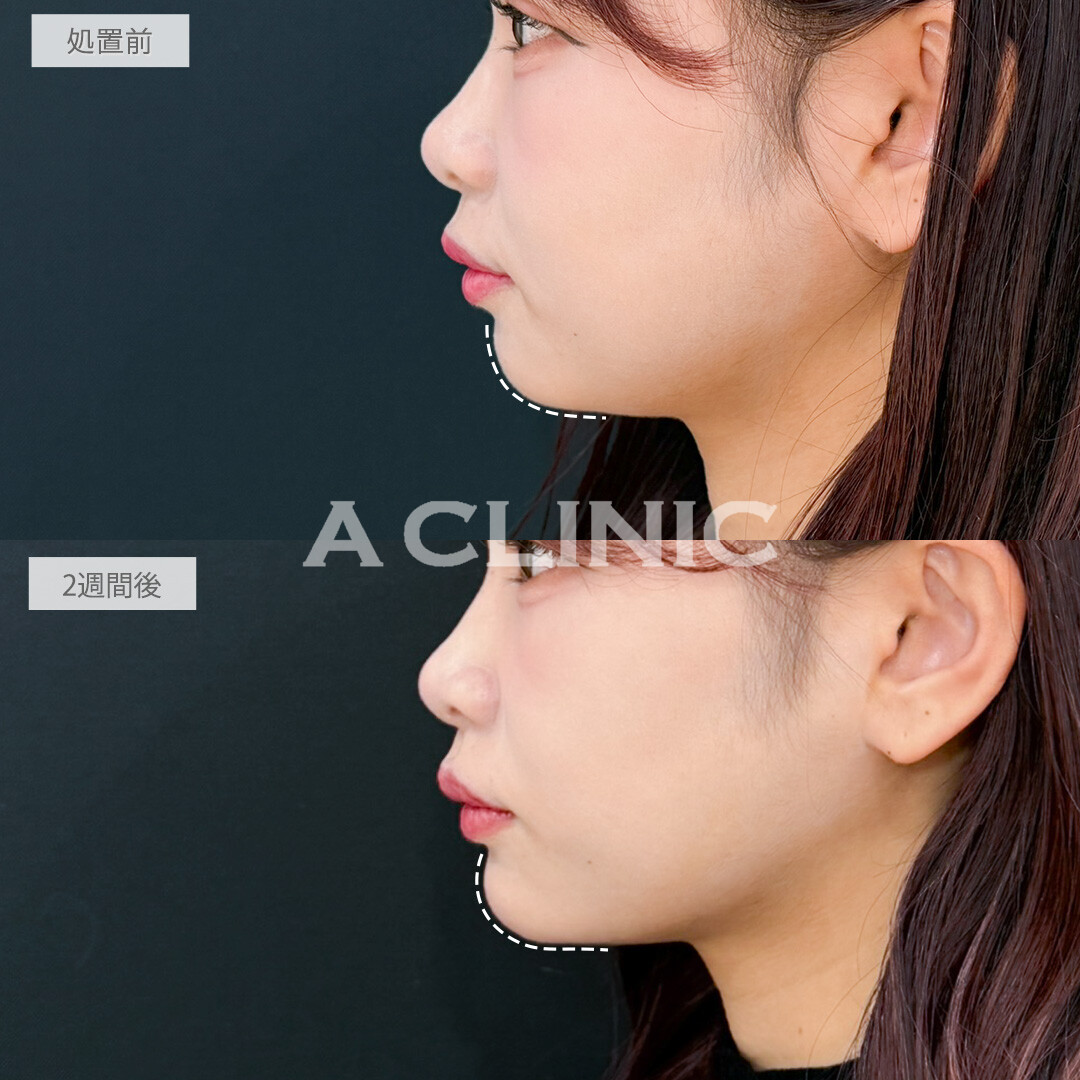 ヒアルロン酸カスタマイズメニューで部分ごとに悩みが解消できて自然なアップデートができました！処置前と2週間後の症例です(20代女性)