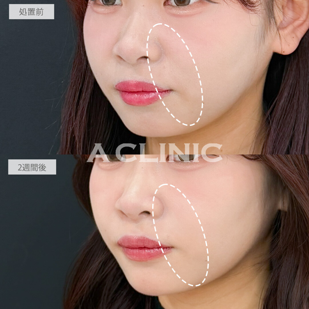 ヒアルロン酸カスタマイズメニューで部分ごとに悩みが解消できて自然なアップデートができました！処置前と2週間後の症例です(20代女性)