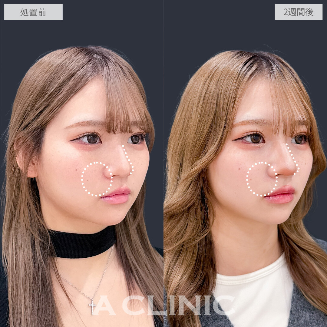 ヒアルロン酸カスタマイズメニューで鼻としわのお悩み同時に解決できました！こちら処置前と2週間後の症例です(20代女性)