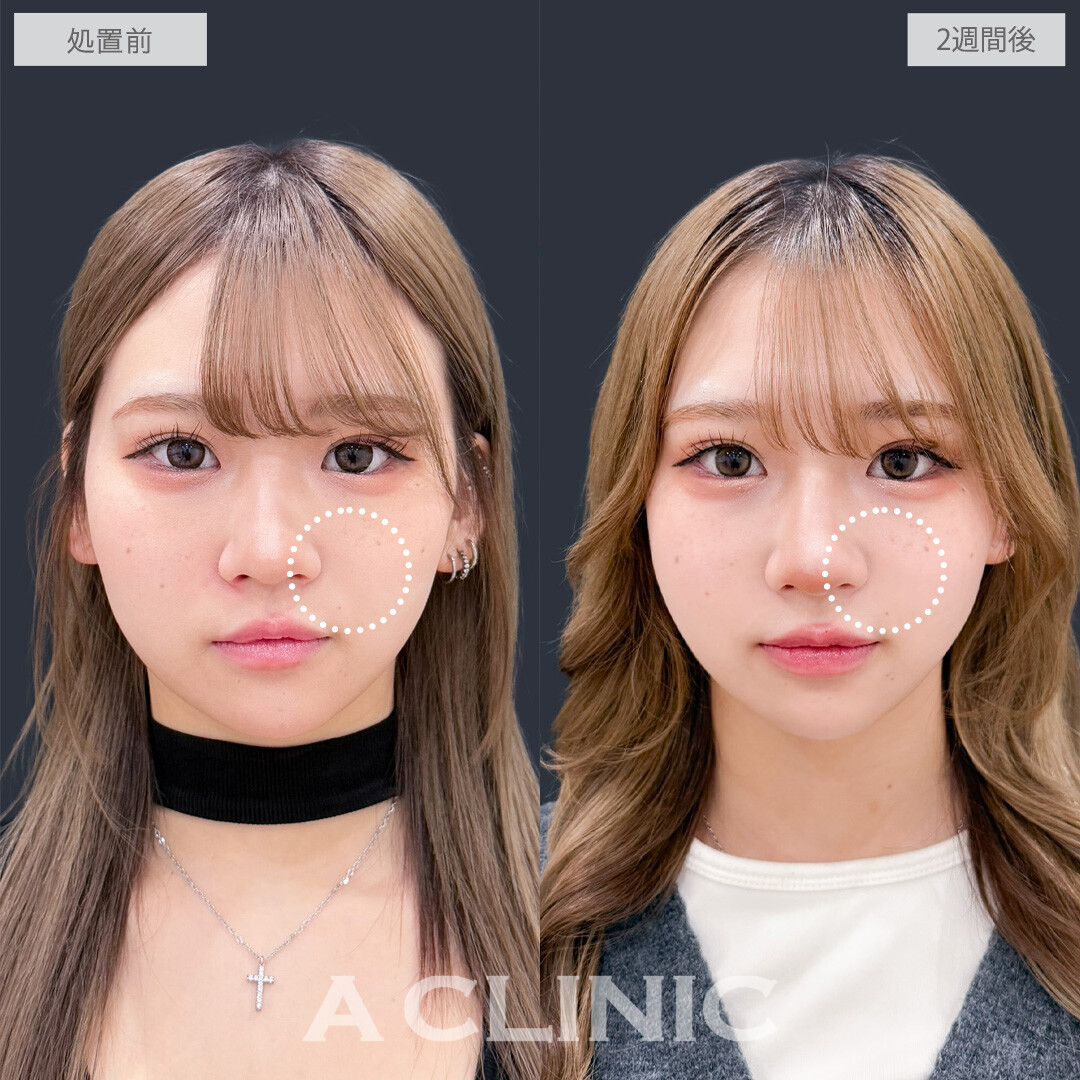 ヒアルロン酸カスタマイズメニューで鼻としわのお悩み同時に解決できました！こちら処置前と2週間後の症例です(20代女性)