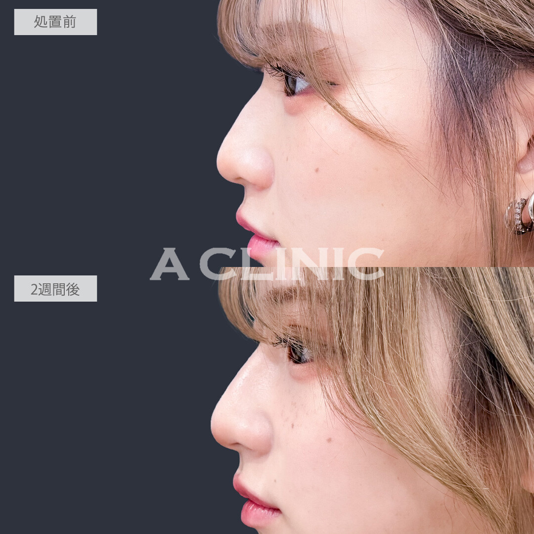 ヒアルロン酸カスタマイズメニューで鼻としわのお悩み同時に解決できました！こちら処置前と2週間後の症例です(20代女性)