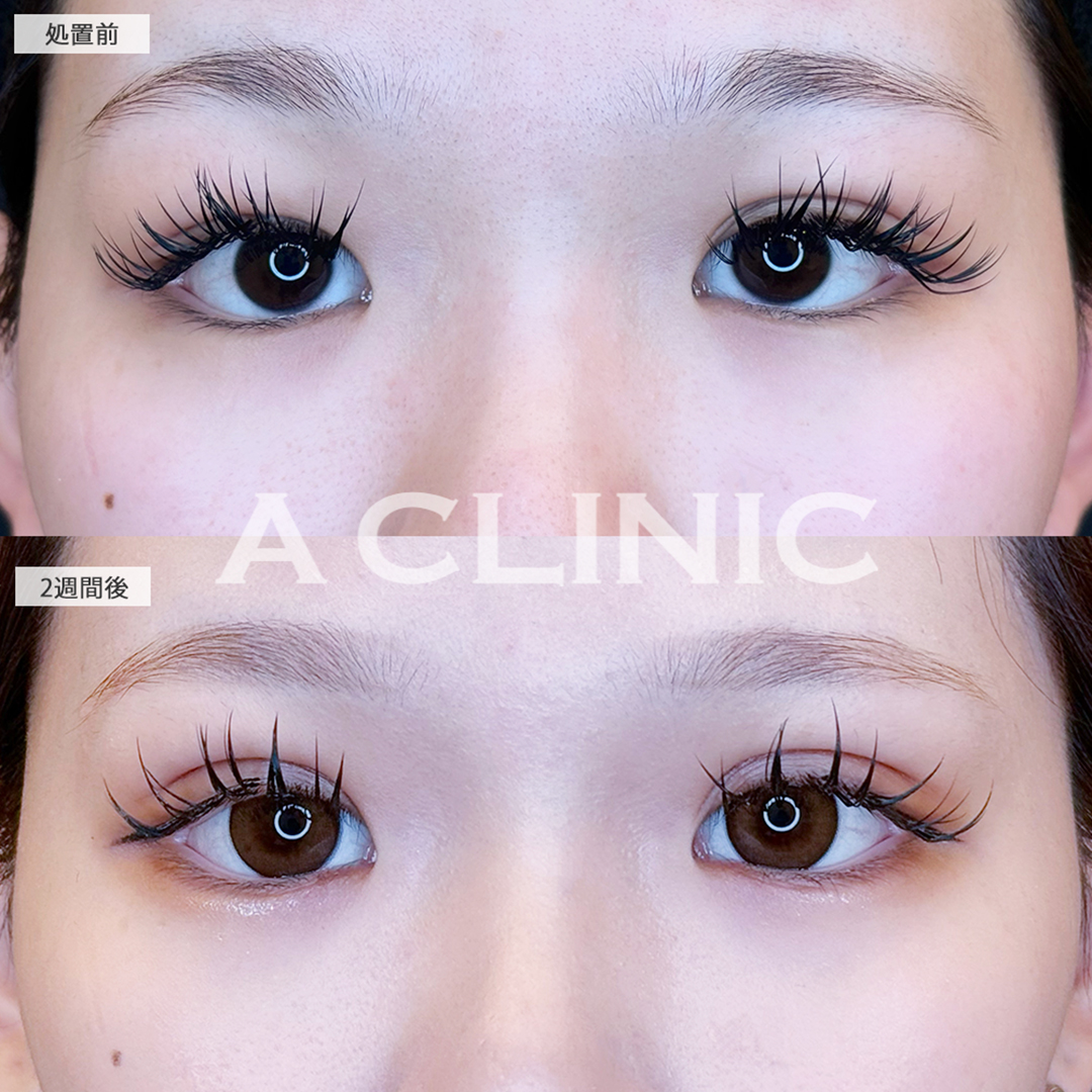 ドーリーアイズでメイク映えする目元をゲット！こちら処置前と2週間後の症例です(10代女性)