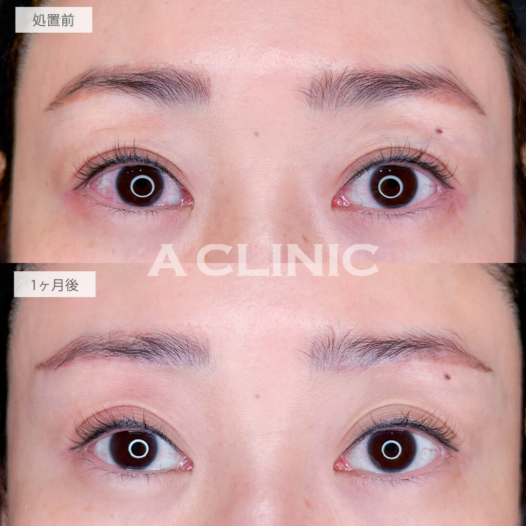 眉下リフトで二重に被さっていた瞼のたるみがなくなり瞼が軽くなって二重も広がりました！処置前と1ヶ月後の症例です(40代女性)