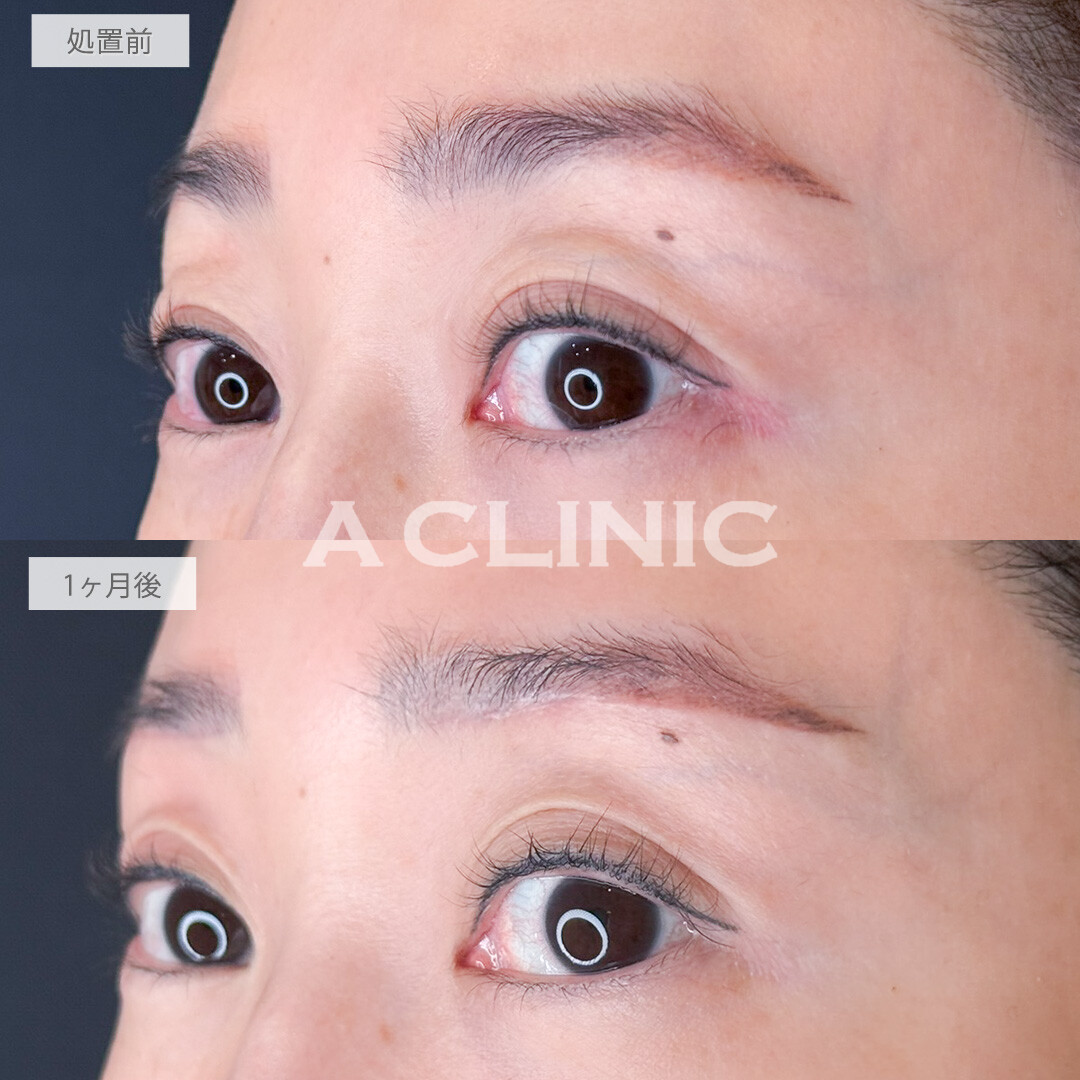 眉下リフトで二重に被さっていた瞼のたるみがなくなり瞼が軽くなって二重も広がりました！処置前と1ヶ月後の症例です(40代女性)
