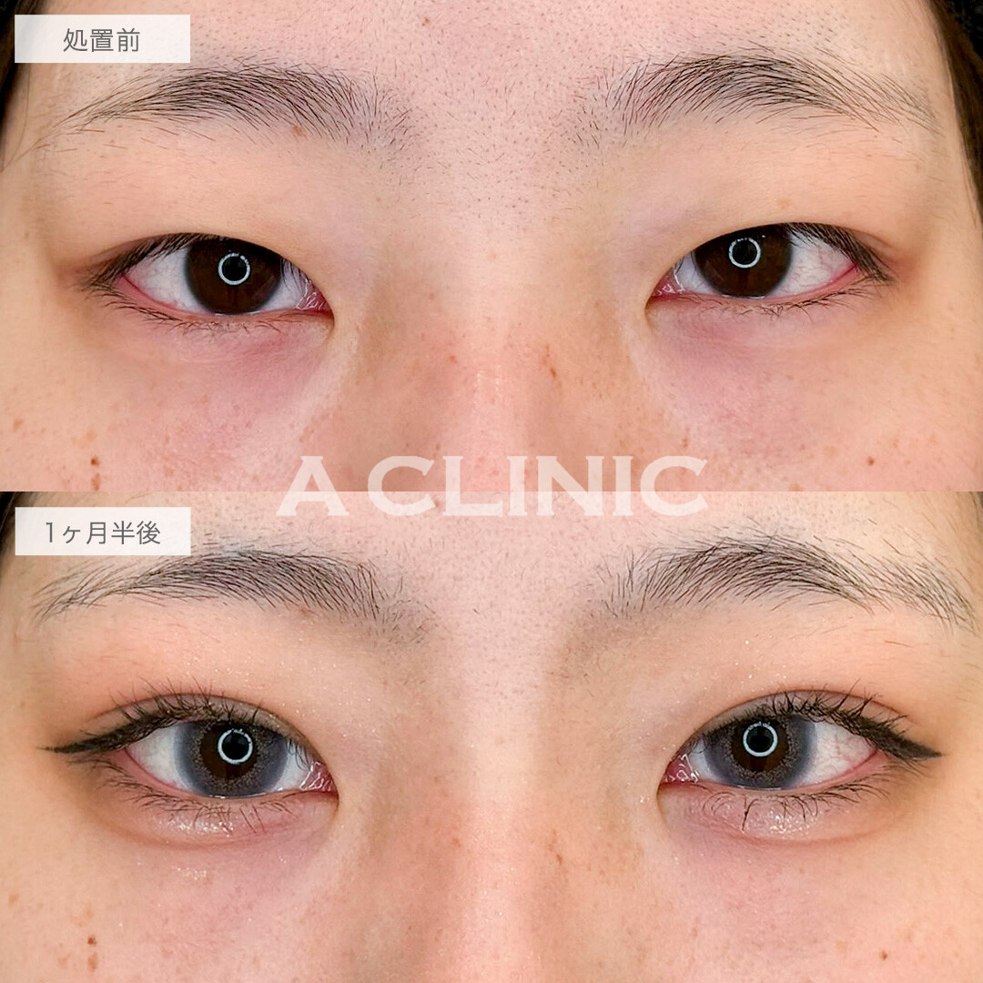 二重術埋没法でずっと悩んでた一重から憧れの二重になりました!こちら処置前と1ヶ月半後の症例です(20代女性)