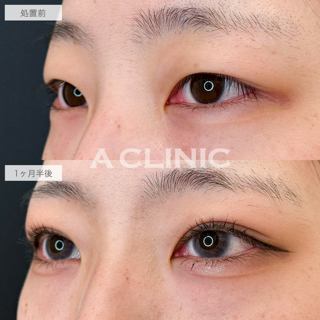 二重術埋没法でずっと悩んでた一重から憧れの二重になりました!こちら処置前と1ヶ月半後の症例です(20代女性)