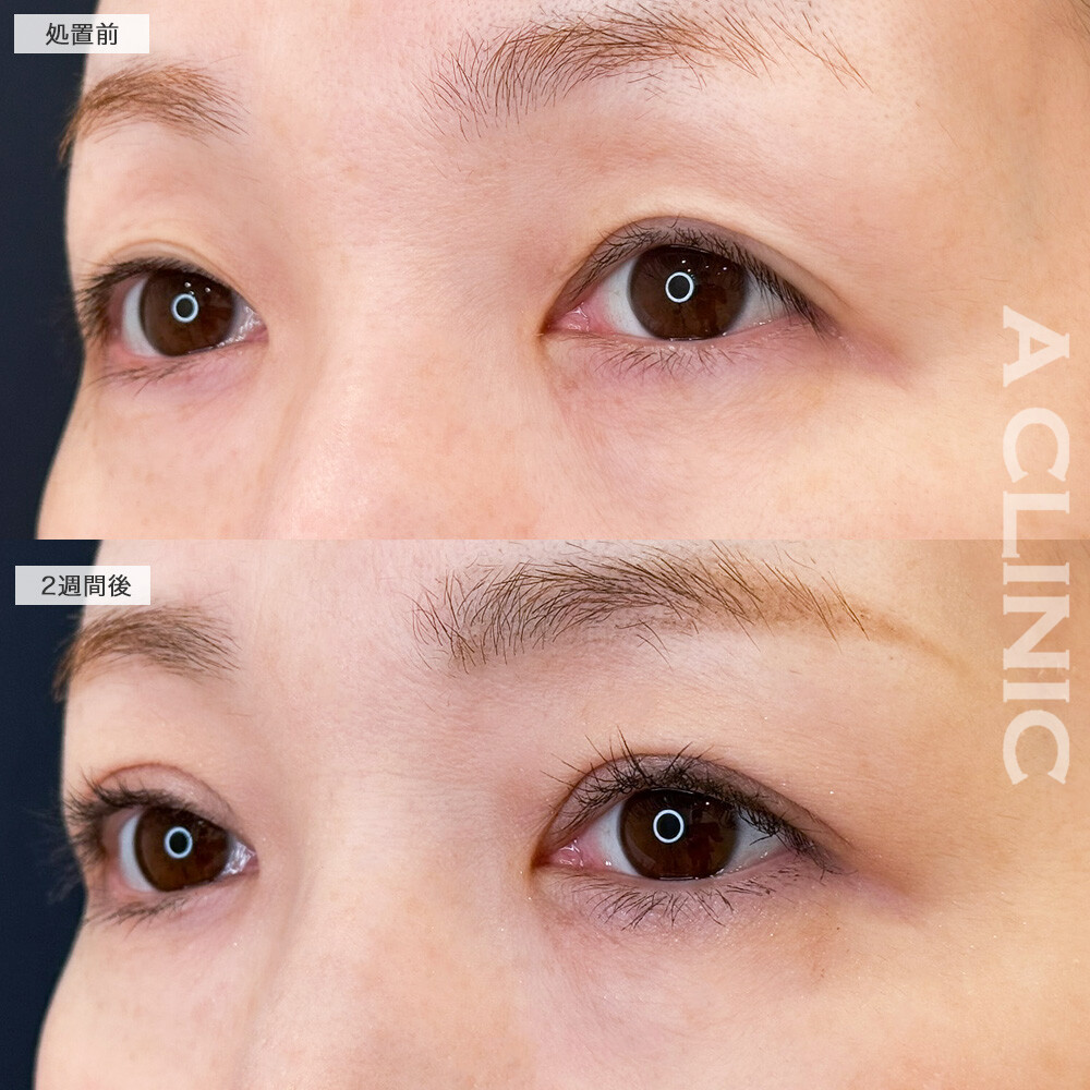 二重術埋没法でまぶたのたるみを解消しぱっちりな目元へ！こちら処置前と2週間後の症例です(30代女性)