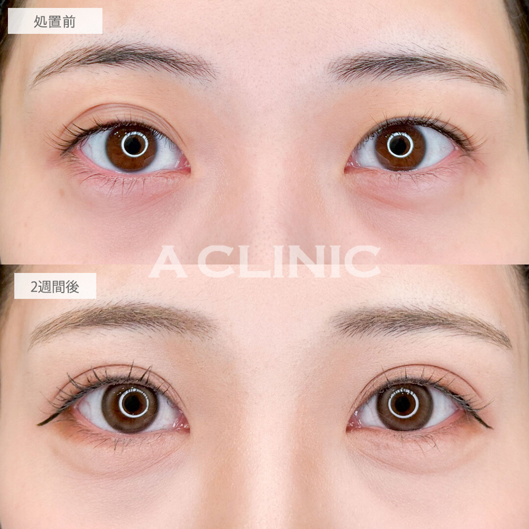 二重術埋没法で左右差を綺麗に改善！こちら処置前と2週間後の症例です(20代女性)