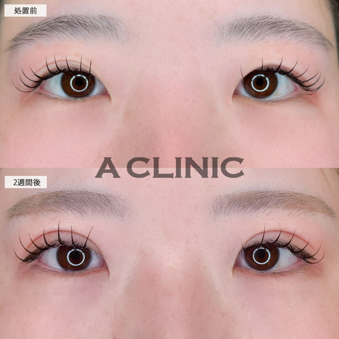 二重術埋没法で二重幅が広がり可愛らしい目元になりました！こちら処置前と2週間後の症例です(20代女性)