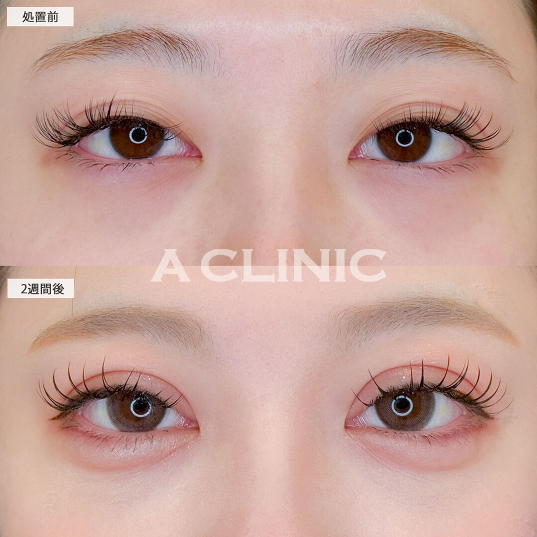 二重術埋没法と涙袋形成術(ヒアルロン酸)で目元が一気に華やかに！こちら処置前と2週間後の症例です(20代女性)