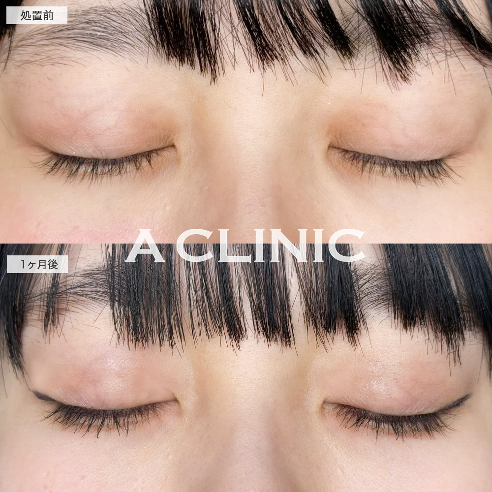 二重術埋没法で左右差を整え理想のお目元へ！こちら処置前と1ヶ月後の症例です(20代女性)