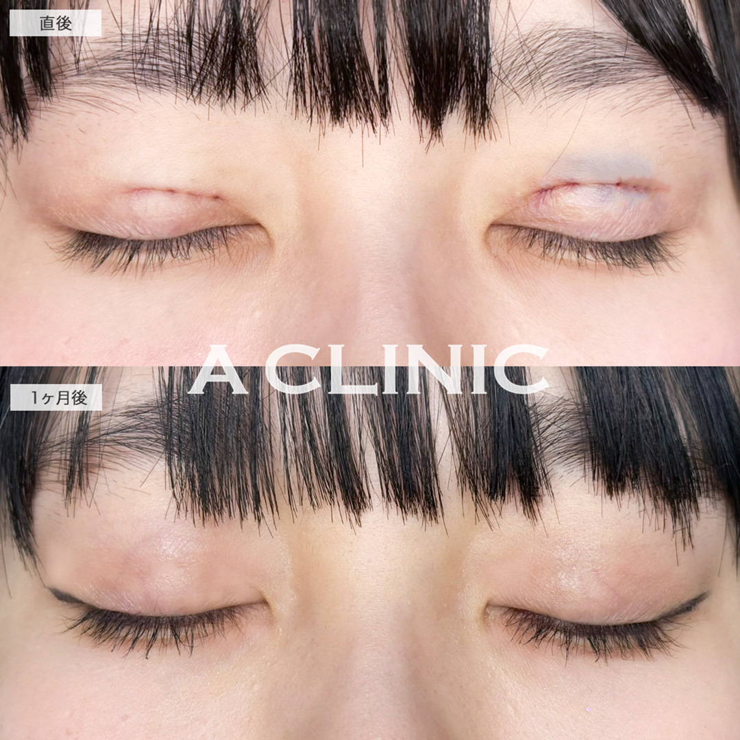 二重術埋没法で左右差を整え理想のお目元へ！こちら処置前と1ヶ月後の症例です(20代女性)