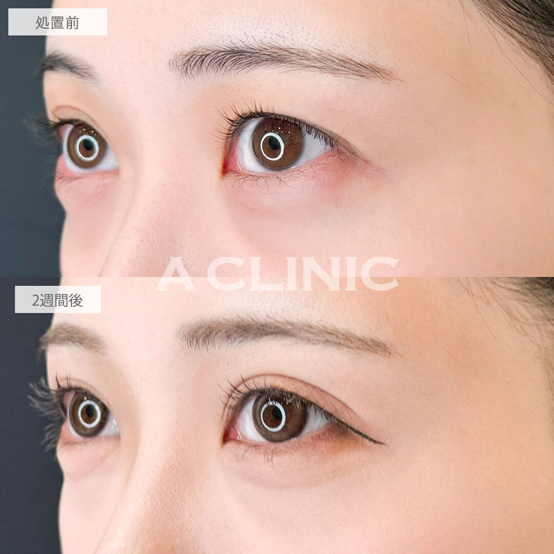 二重術埋没法で左右差を綺麗に改善！こちら処置前と2週間後の症例です(20代女性)