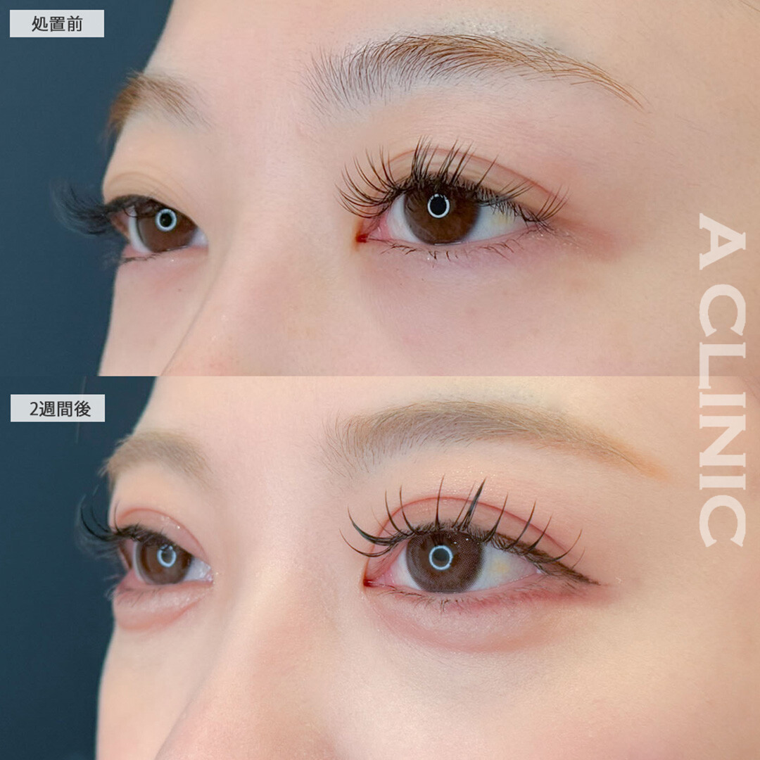 二重術埋没法と涙袋形成術(ヒアルロン酸)で目元が一気に華やかに！こちら処置前と2週間後の症例です(20代女性)