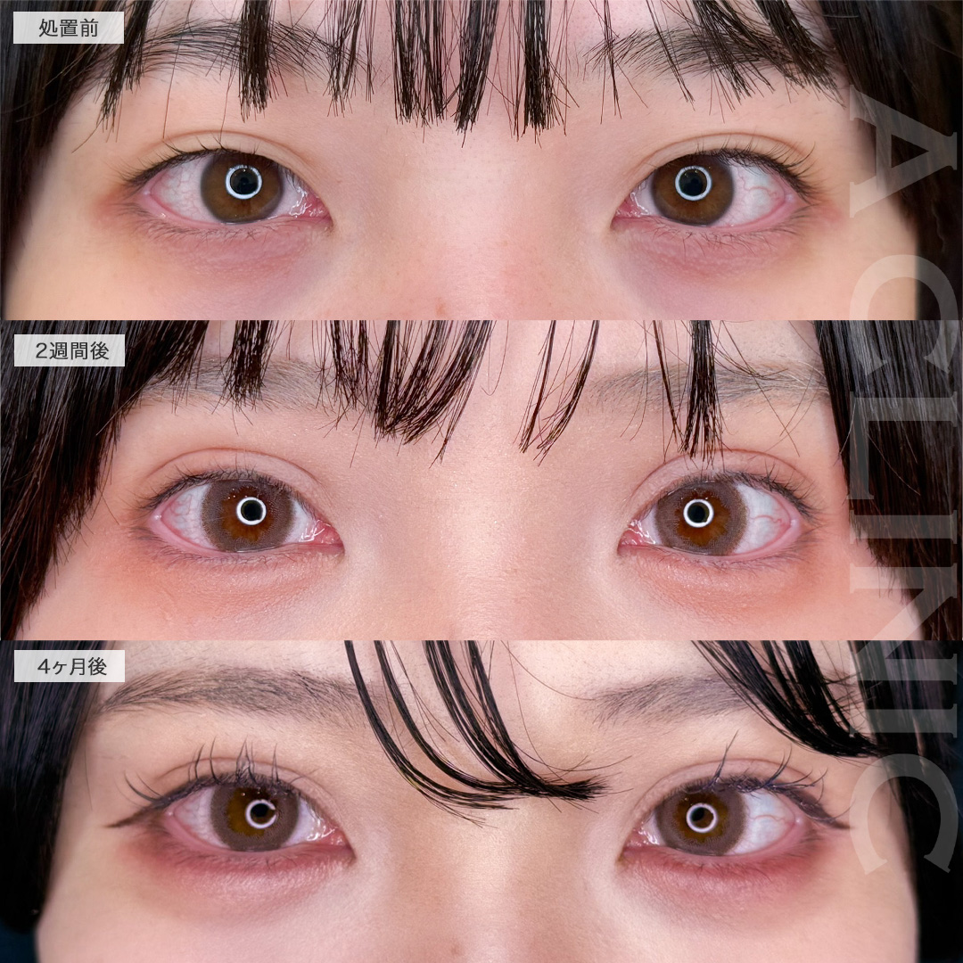 二重術埋没法ですっぴんでも盛れる二重に！こちら処置前から5ヶ月後の症例です(20代女性)