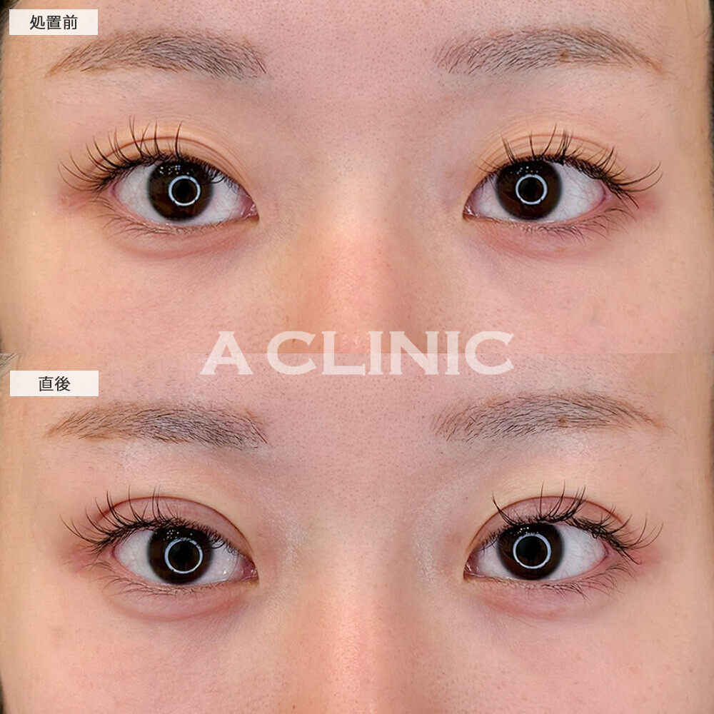 二重術埋没法で眠そうに見える目元が改善されました！こちら処置前と直後の症例です(20代女性)