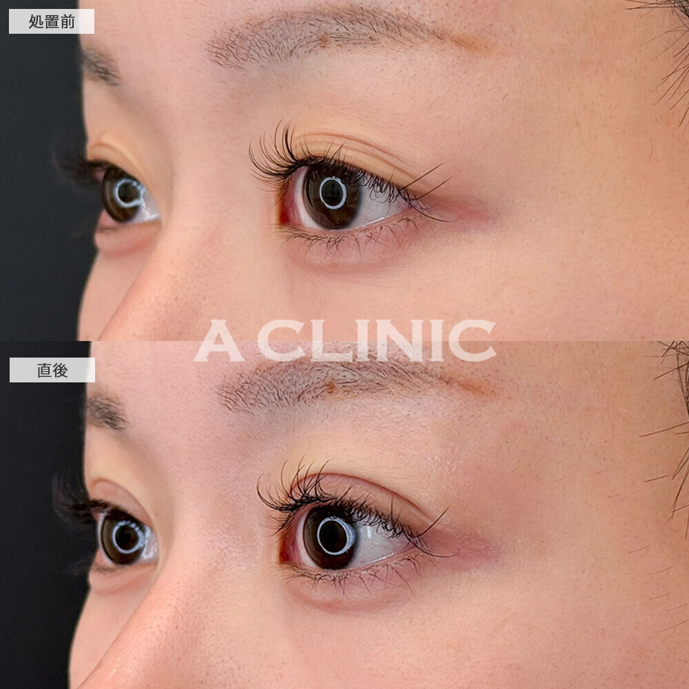 二重術埋没法で眠そうに見える目元が改善されました！こちら処置前と直後の症例です(20代女性)