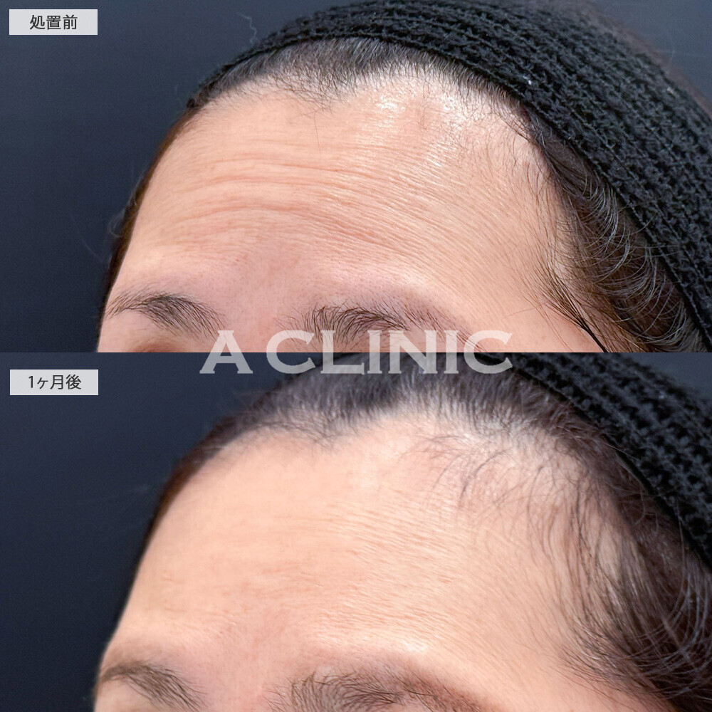 ボトックス注射(しわ)で老け顔の原因となる額と目元のシワ改善！こちら処置前と1ヶ月後の症例です(40代女性)