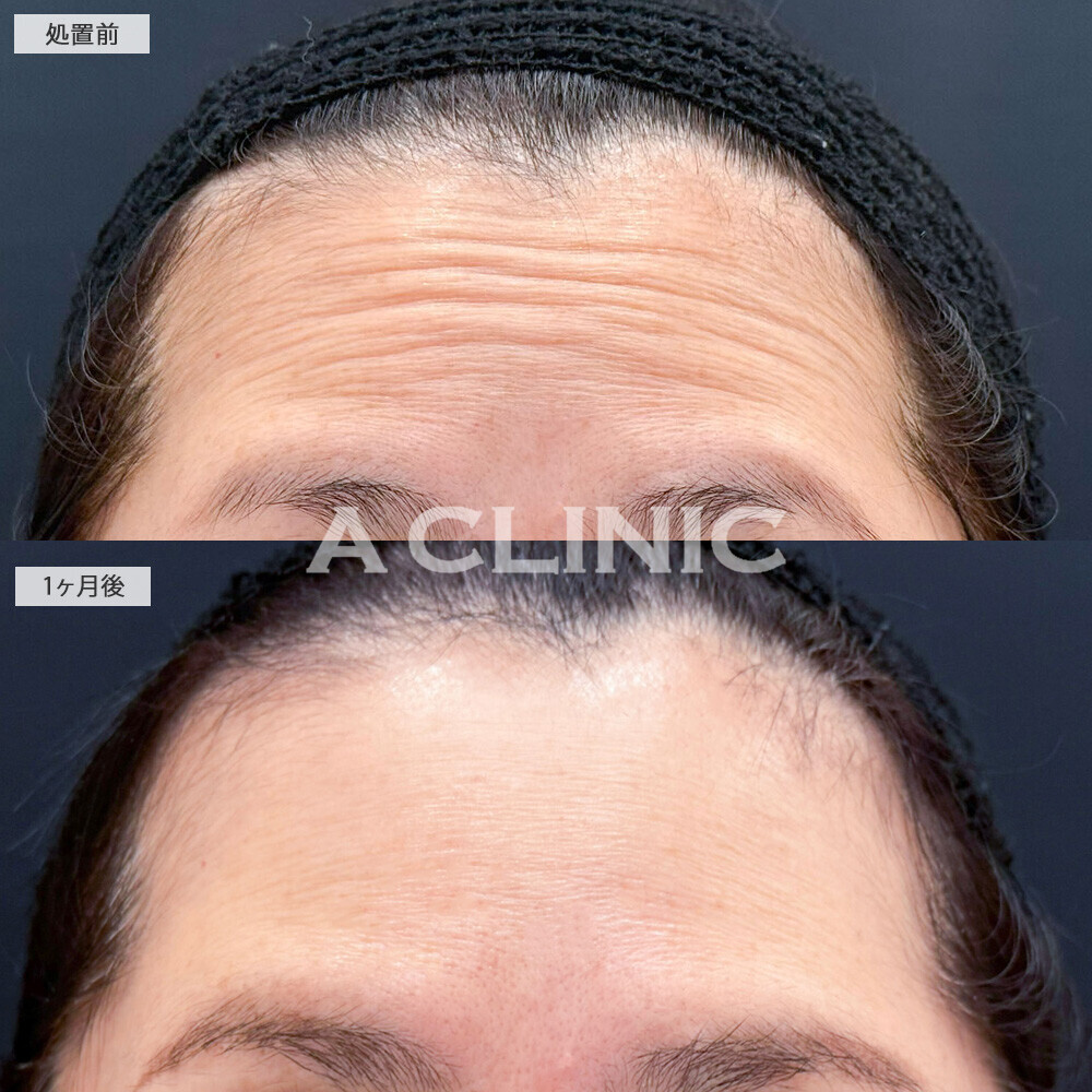 ボトックス注射(しわ)で老け顔の原因となる額と目元のシワ改善！こちら処置前と1ヶ月後の症例です(40代女性)