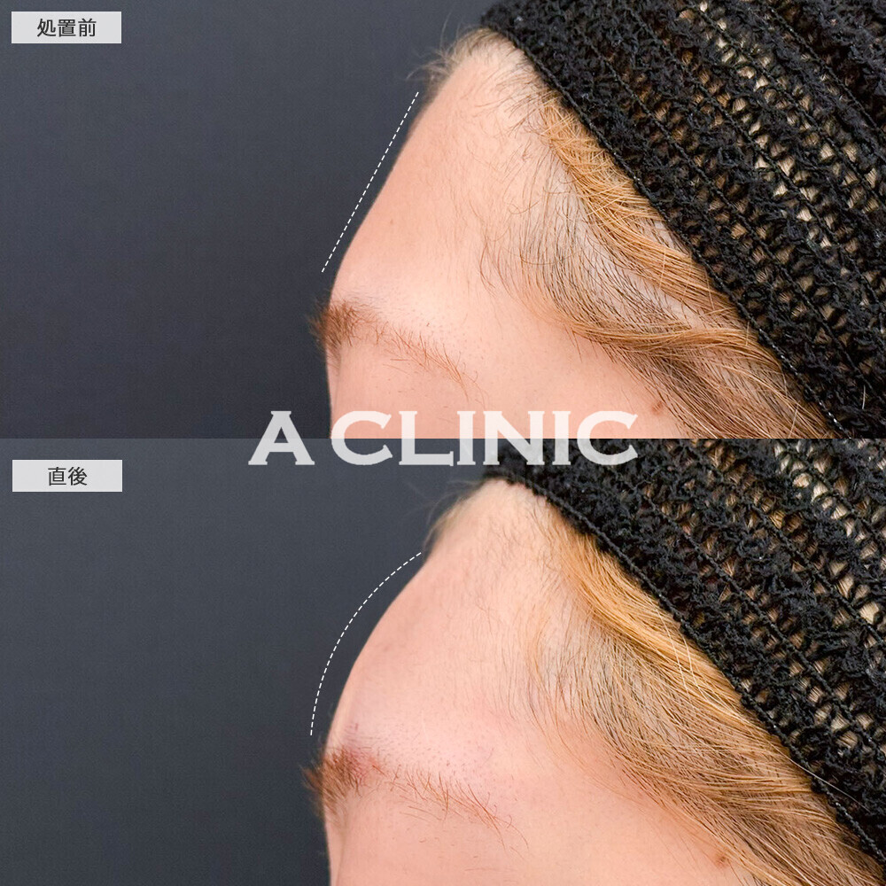 額出し(ヒアルロン酸注入)で女性らしい丸みのあるおでこに！こちら処置前と直後の症例です(20代女性)