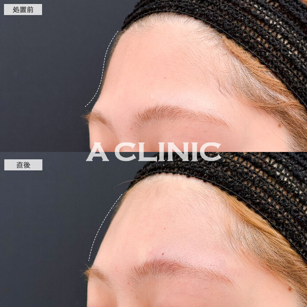 額出し(ヒアルロン酸注入)で女性らしい丸みのあるおでこに！こちら処置前と直後の症例です(20代女性)