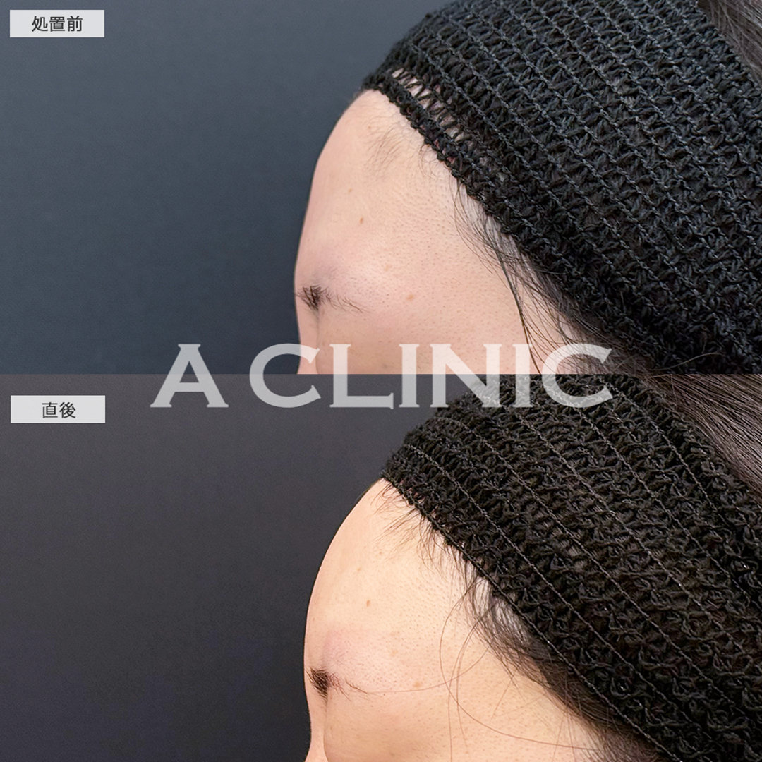 額出し(ヒアルロン酸注入)で立体感のあるおでこになりました！こちら処置前と直後の症例です(20代女性)