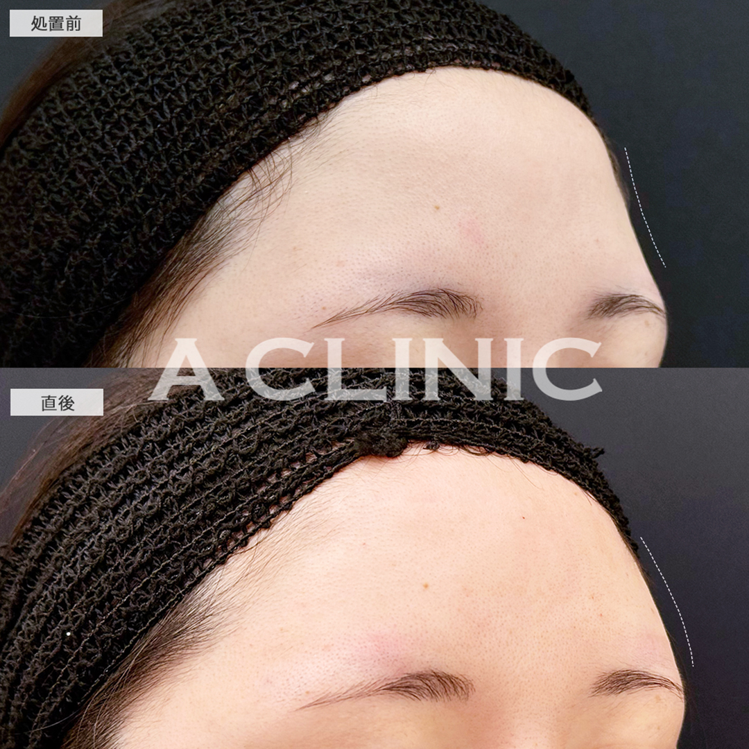 額出し(ヒアルロン酸注入)で立体感のあるおでこになりました！こちら処置前と直後の症例です(20代女性)