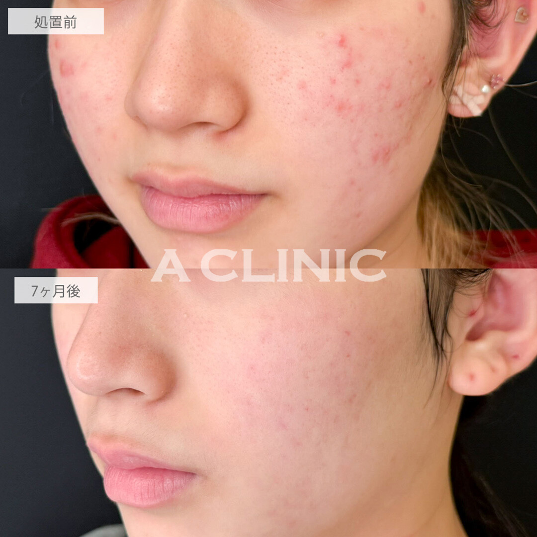 イソトレチノインでニキビ改善しつつ透明感のある肌へ！こちら処置前と7ヶ月後の症例です(20代女性)