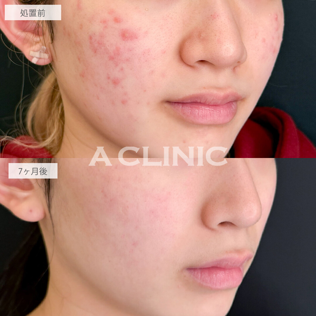 イソトレチノインでニキビ改善しつつ透明感のある肌へ！こちら処置前と7ヶ月後の症例です(20代女性)