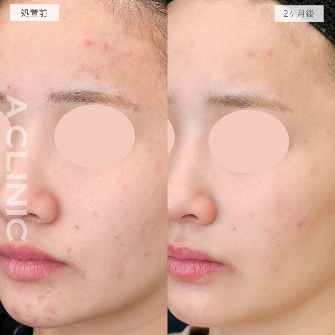 イソトレチノインでニキビのできやすいおでことあごも2ヶ月で落ち着いてきました！処置前と2ヶ月後の症例です(20代女性)