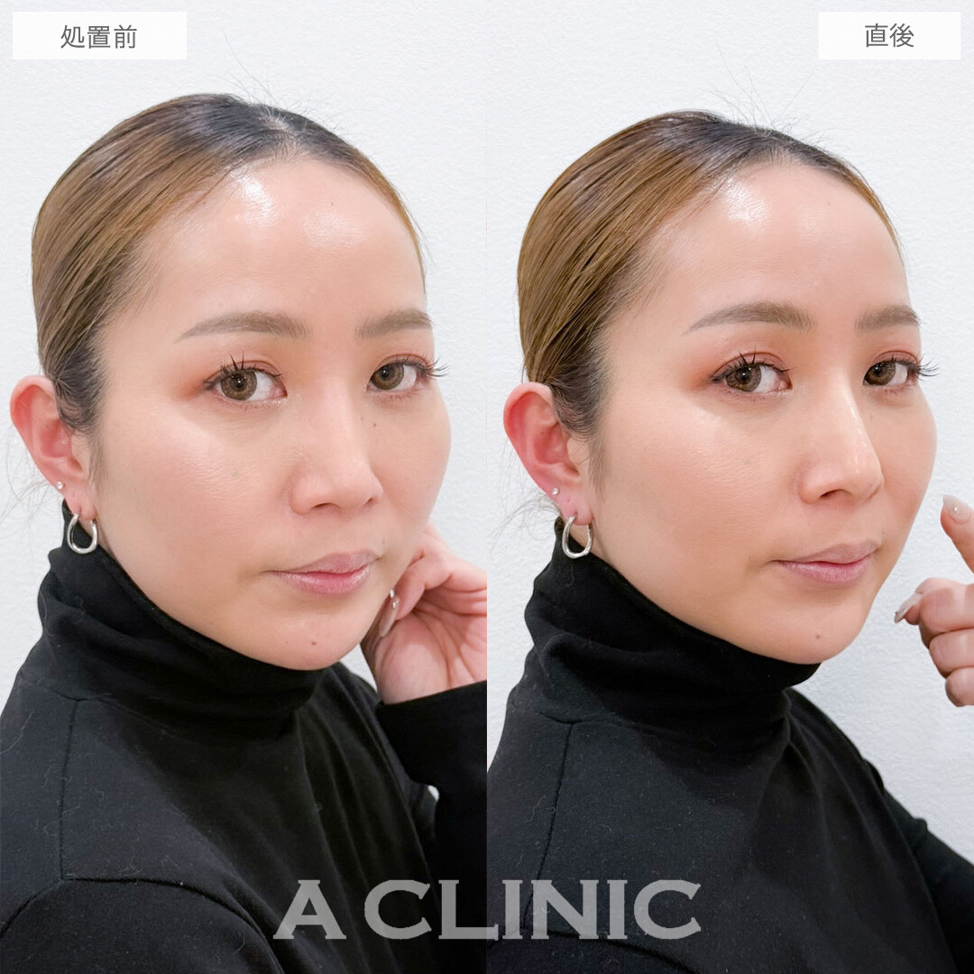 ジャスミンノーズは注入だけで手軽に憧れの鼻を手に入れられます！こちら処置前と直後の症例です(40代女性)