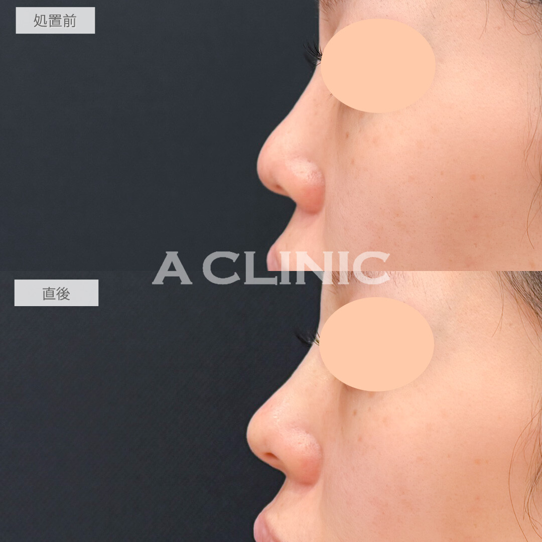 ジャスミンノーズで丸い鼻先もツンと尖らせることができました！処置前と直後の症例です(20代女性)