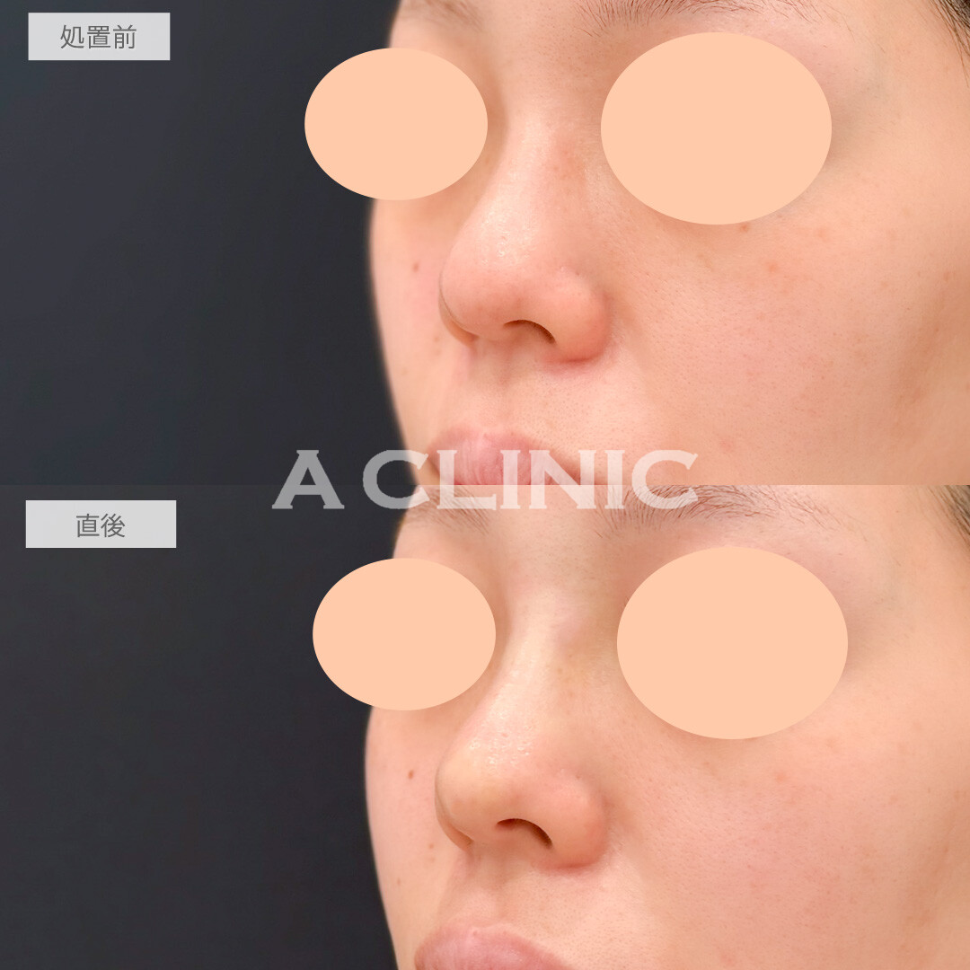 ジャスミンノーズで丸い鼻先もツンと尖らせることができました！処置前と直後の症例です(20代女性)
