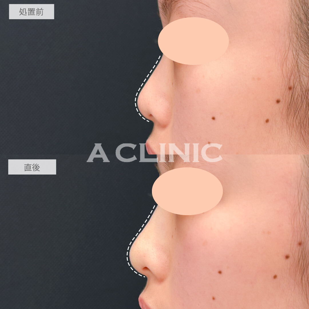 ジャスミンノーズで立体感が出て一気に垢抜け！処置前と直後の症例です(20代女性)