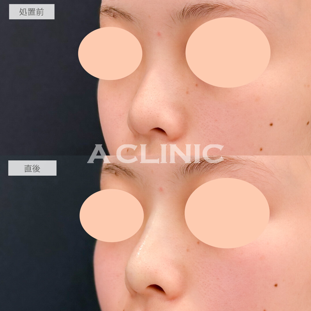 ジャスミンノーズで立体感が出て一気に垢抜け！処置前と直後の症例です(20代女性)