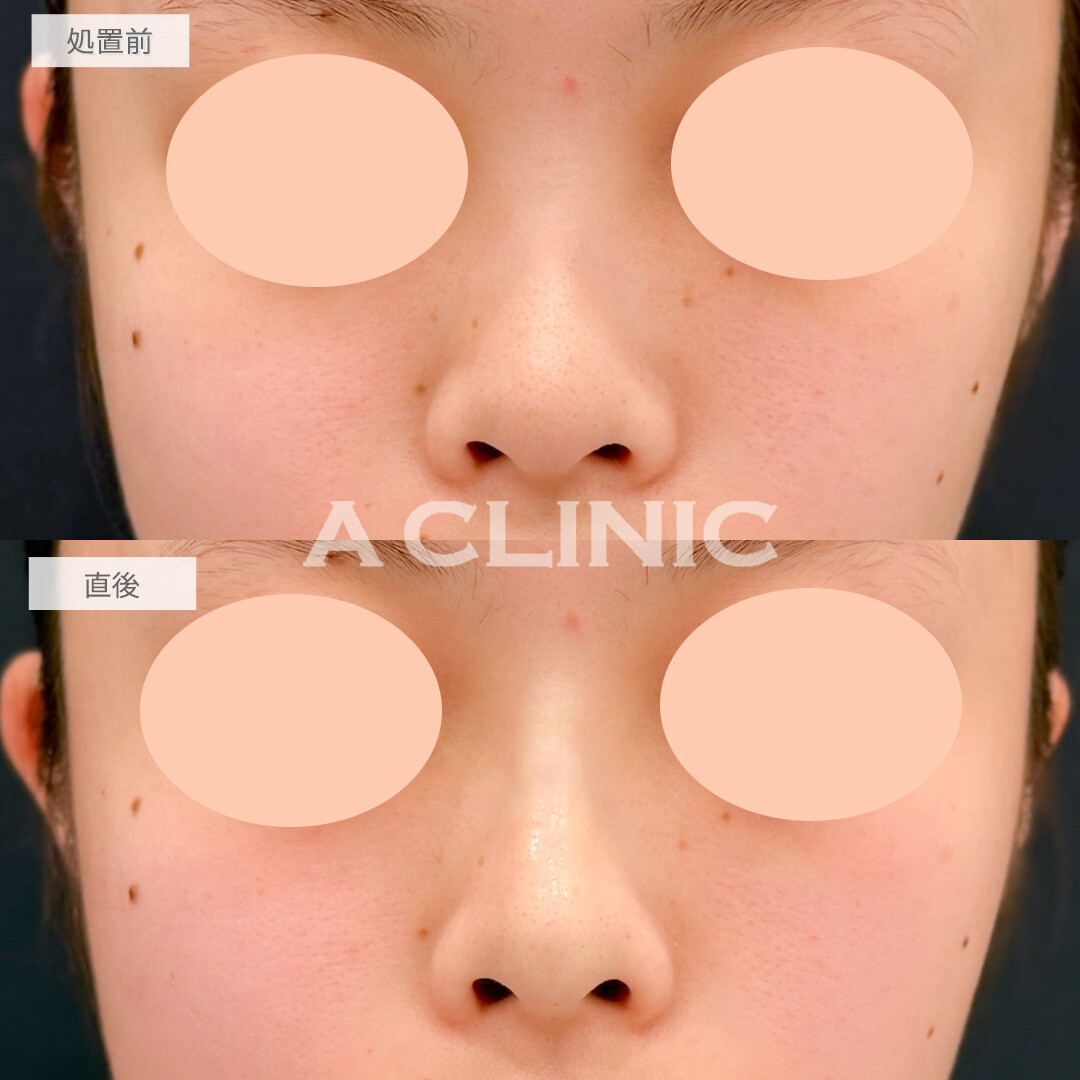 ジャスミンノーズで立体感が出て一気に垢抜け！処置前と直後の症例です(20代女性)
