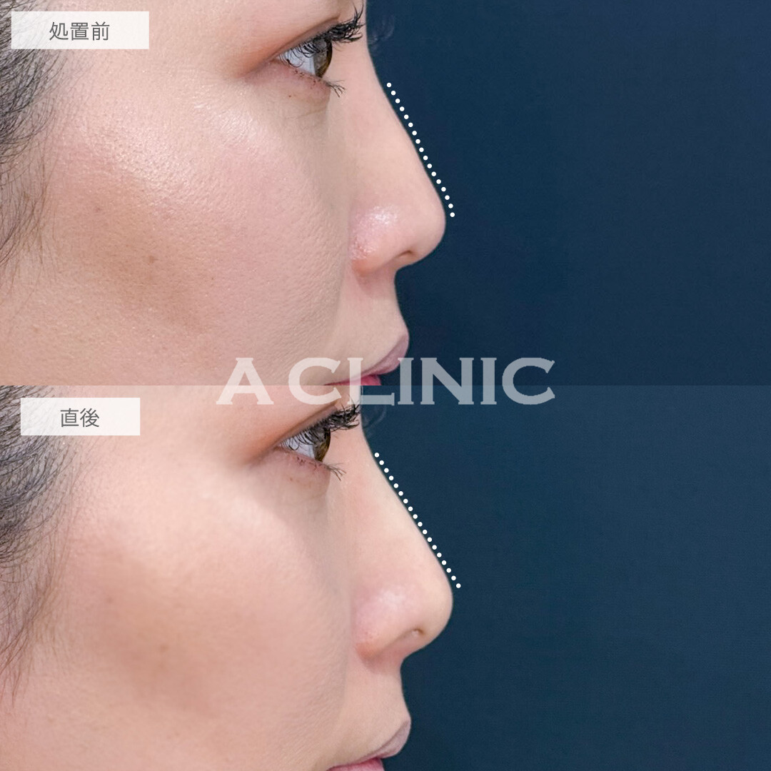 ジャスミンノーズは注入だけで手軽に憧れの鼻を手に入れられます！こちら処置前と直後の症例です(40代女性)