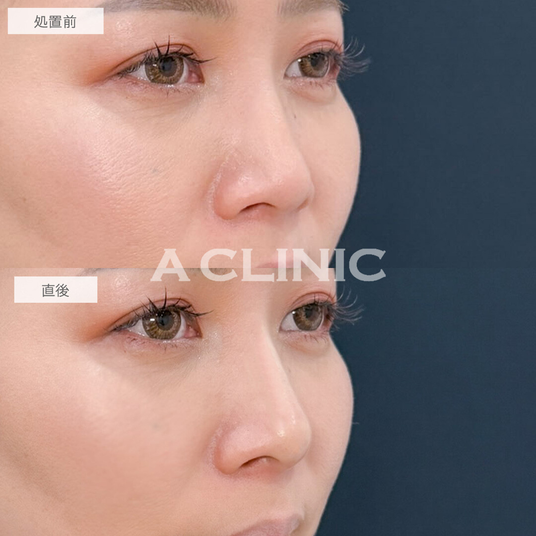 ジャスミンノーズは注入だけで手軽に憧れの鼻を手に入れられます！こちら処置前と直後の症例です(40代女性)