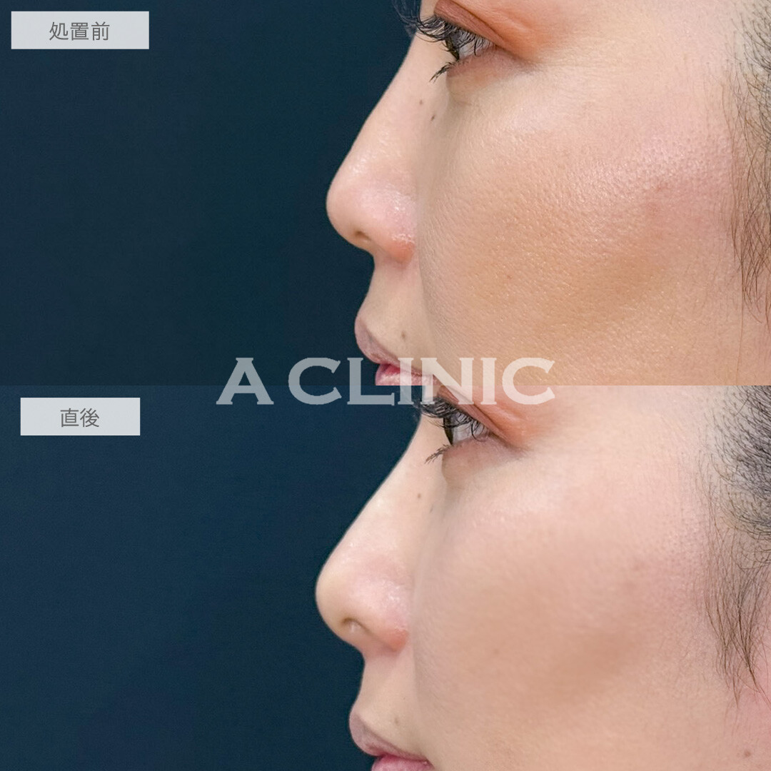 ジャスミンノーズは注入だけで手軽に憧れの鼻を手に入れられます！こちら処置前と直後の症例です(40代女性)