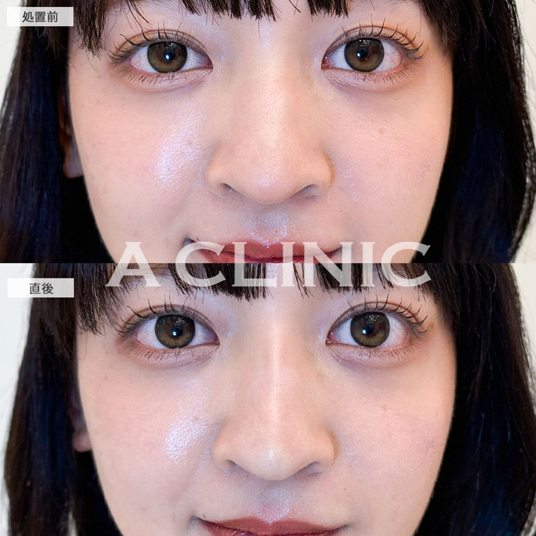 ジャスミンノーズで鷲鼻が改善されどの角度からも盛れるようになりました！こちら処置前と直後の症例です(20代女性)