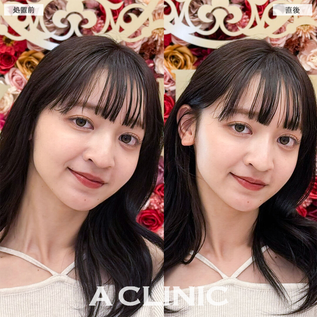 ジャスミンノーズで鷲鼻が改善されどの角度からも盛れるようになりました！こちら処置前と直後の症例です(20代女性)