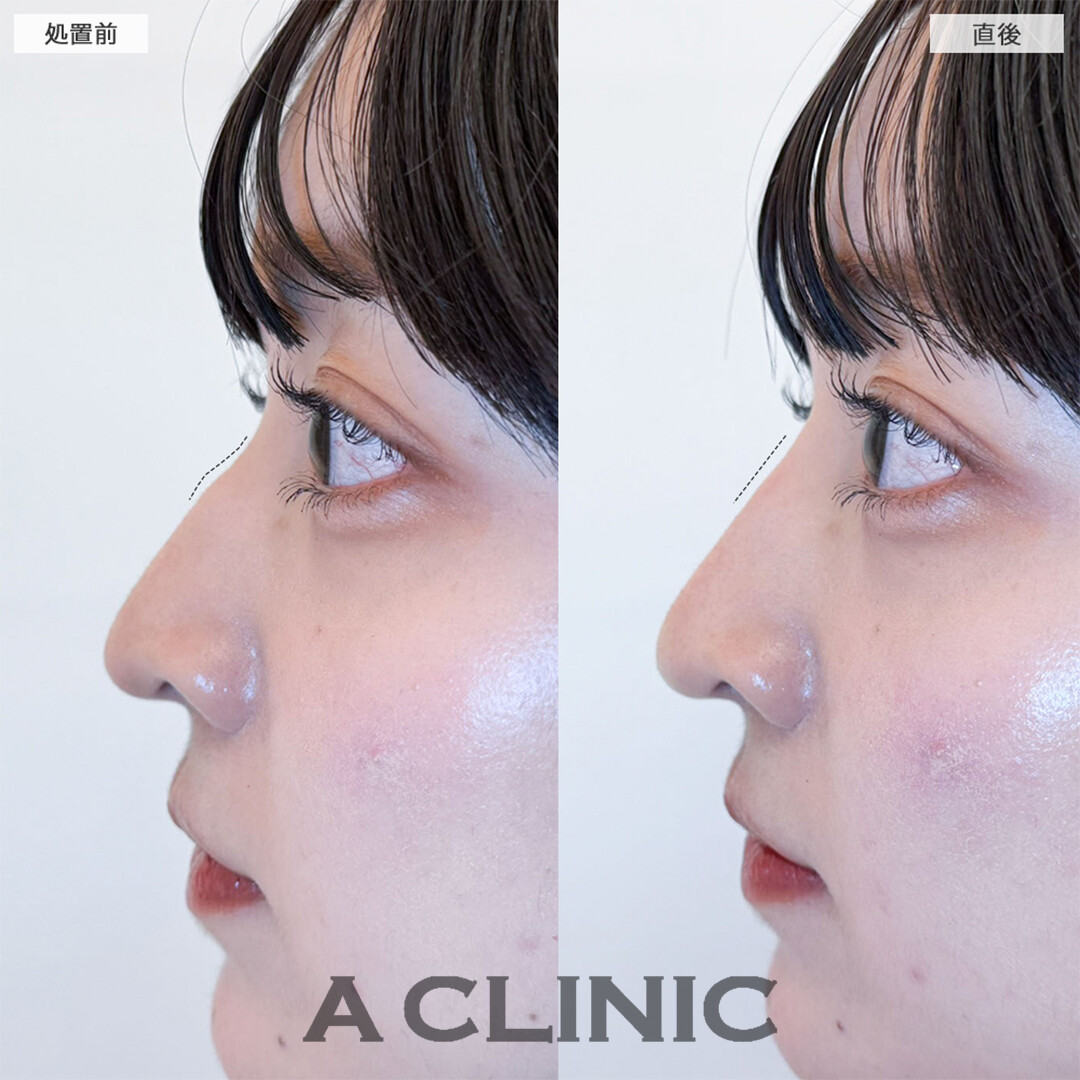 ジャスミンノーズで鷲鼻が改善されどの角度からも盛れるようになりました！こちら処置前と直後の症例です(20代女性)