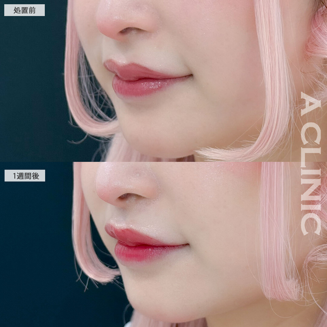 切らない人中短縮(Cカール形成術)で自然と面長が解消されさらに可愛くなりました！こちら処置前と1週間後の症例です(30代女性)