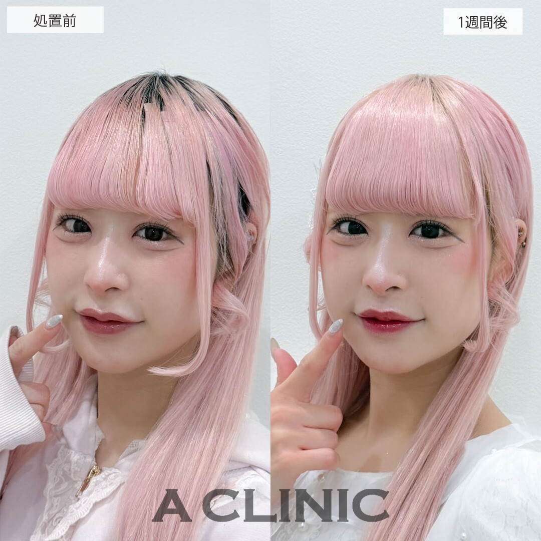 切らない人中短縮(Cカール形成術)で自然と面長が解消されさらに可愛くなりました！こちら処置前と1週間後の症例です(30代女性)